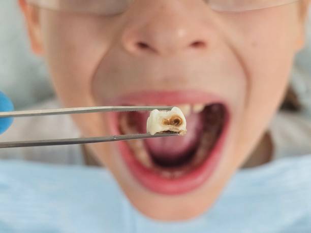 Best Emergency Treatment for Toothache in Keystone Heights, FL